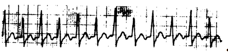 Рис.1. Электрокардиограмма, показывающая чередование амплитуд комплекса QRS при суправентрикулярной тахикардии